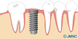 im_implant03