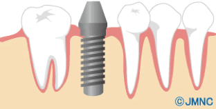 im_implant04