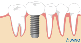 im_implant05